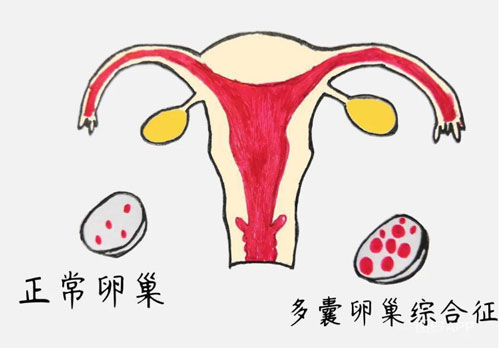 卵巢多囊性改变是什么？具有月经紊乱、闭经、无排卵等症状。