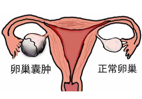 卵巢囊肿会导致卵巢早衰吗？及时发现进行处理为上！