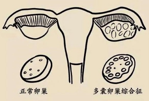 多囊卵巢常见吗？多囊卵巢是怎么样的？